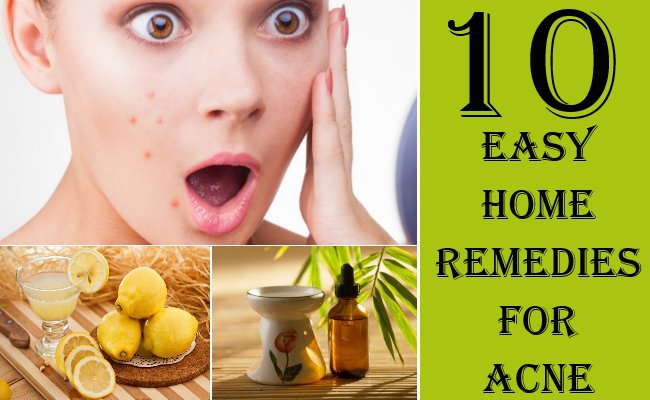 easy-home-remedies-for-acne