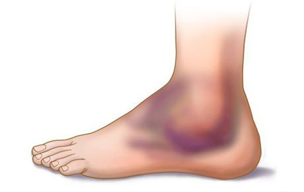 footcontusion