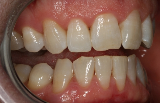 gum-disease-after-treatment