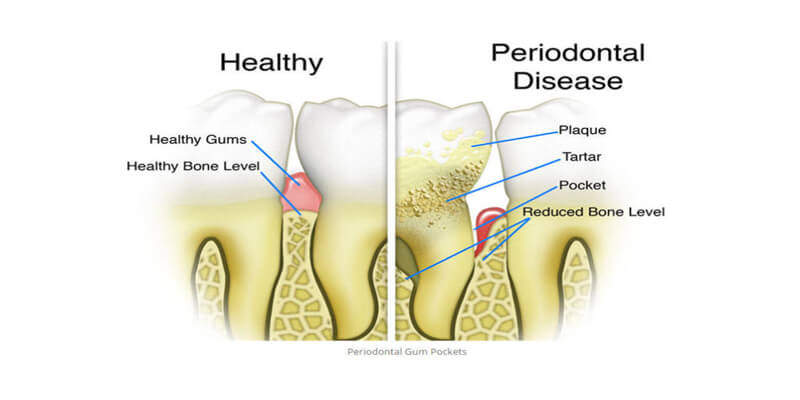 periodontal-disease-7