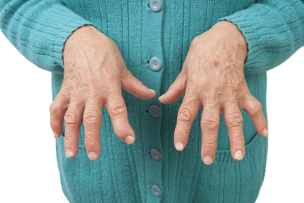 rheumatoid-arthritis-hands-2 ‍ ۶ دلیل جدی و مهم آسیب مفاصل