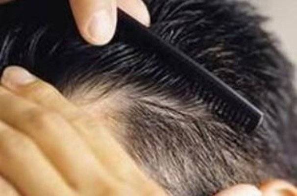 درمان ریزش موی ژنتیک