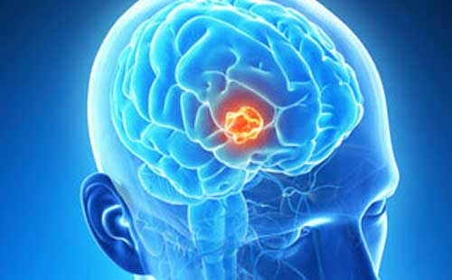درمان سرطان مغز درمان تومور مغز تلفیق دارویی برای درمان سرطان مغز 