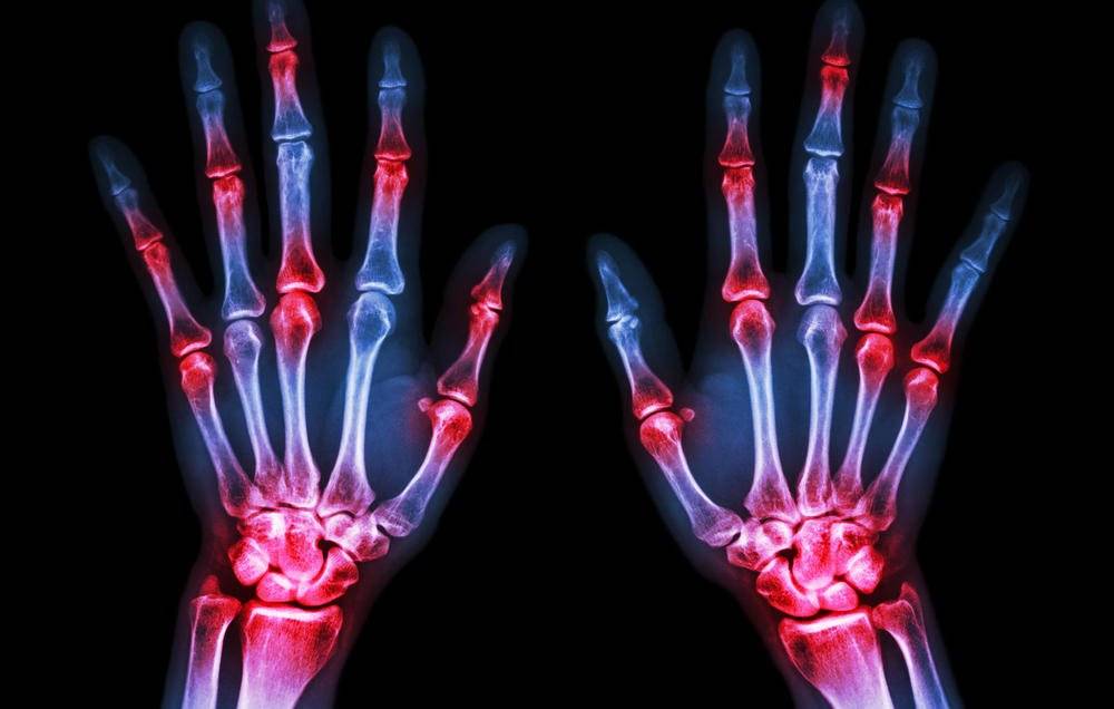نشانه های عفونت آرتریت عوامل ایجاد درد مفصل درد مفاصل 