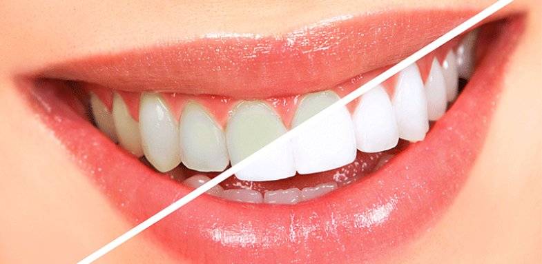 کیت‌های سفیدکننده خانگی سفید کردن دندان‌ روش بلیچینگ 