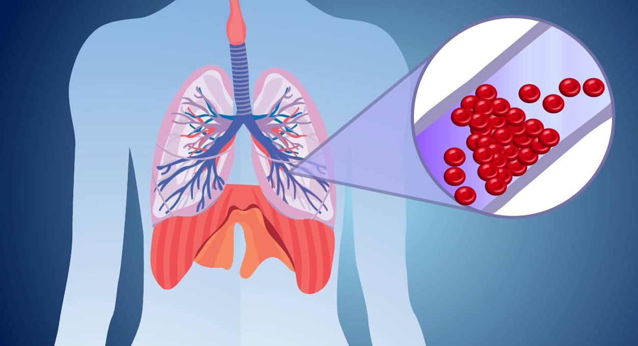 لخته شدن ورید‌های عمقی عوامل بروز آمبولی علائم ترومبوز علائم آمبولی پیشگیری و درمان آمبولی آمبولی ریه 