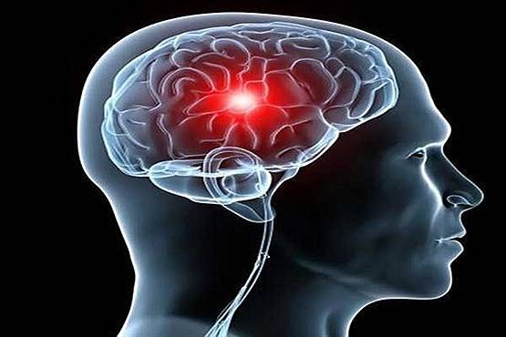 زنگ خطرهای بدن برای سکته مغزی
