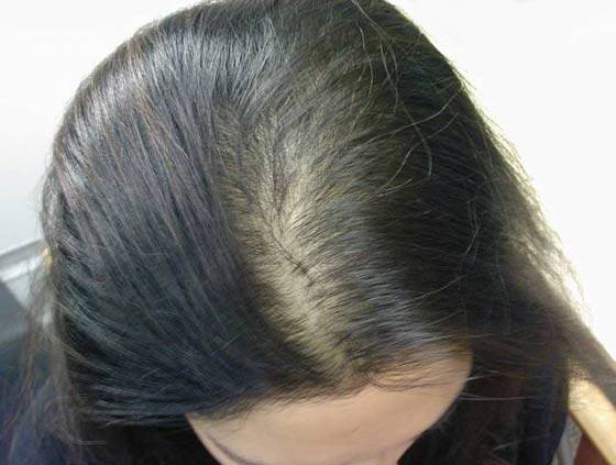 درمان ریزش مو در منزل
