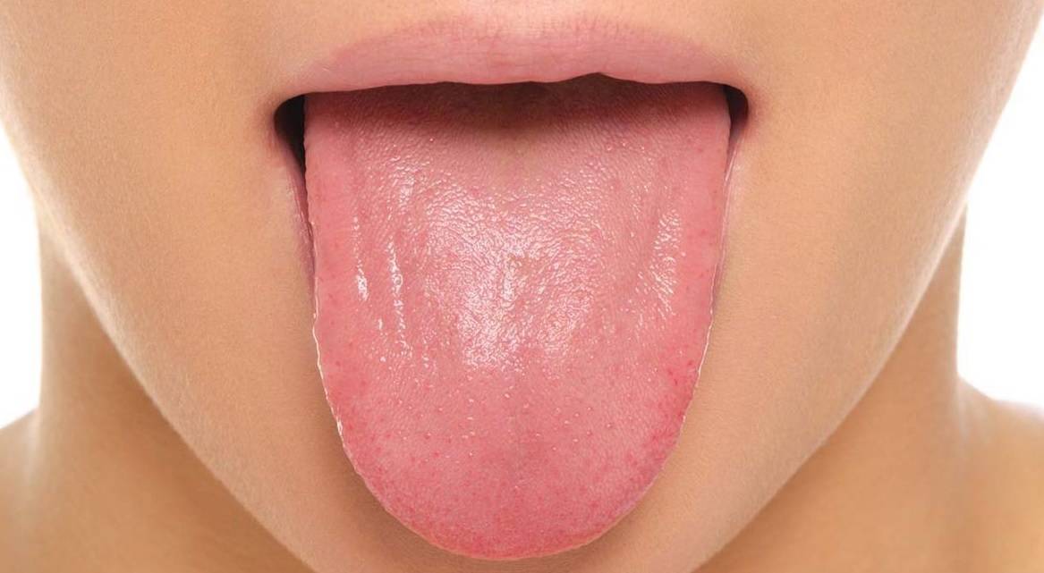 کمبود ویتامین B2 زبان قرمز رنگ زبان زرد رنگ رنگ زبان تغییر رنگ زبان بیماری زبان 