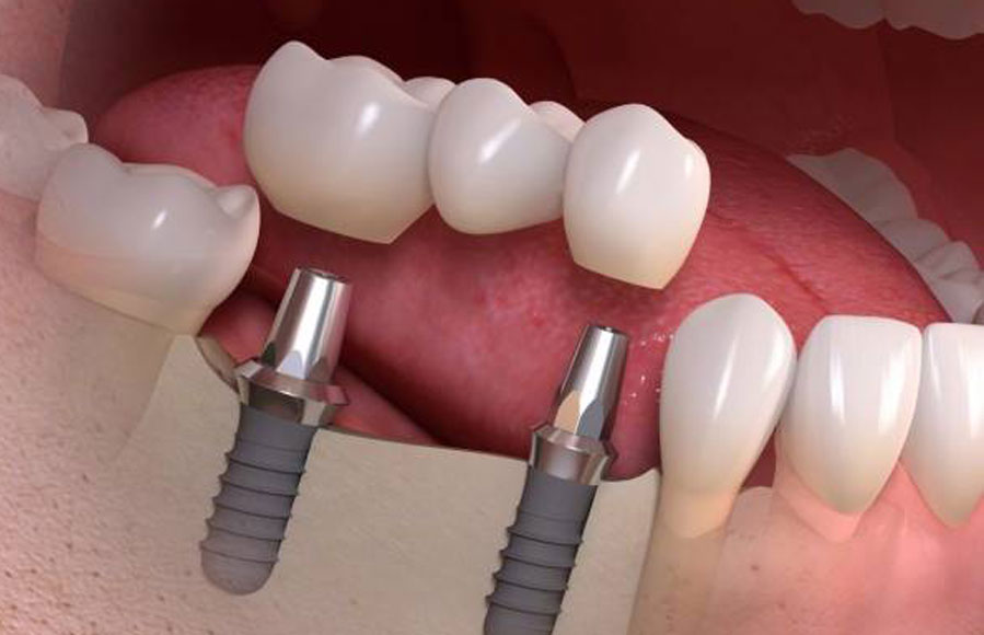 مراقبت از ایمپلنت دندان – قبل و بعد عمل