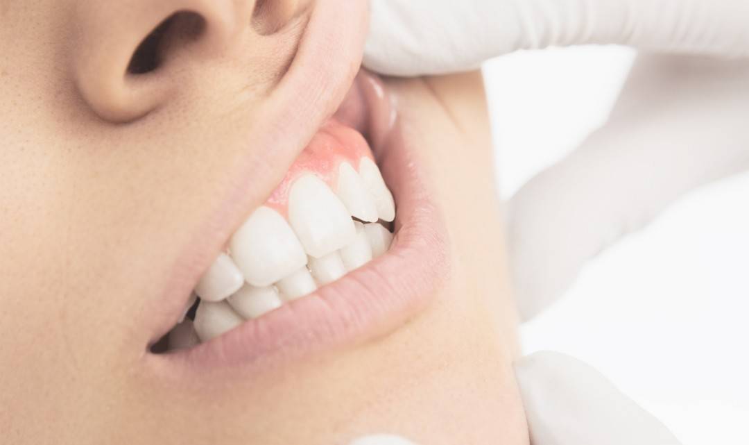 ایمپلنت دندان و مراقبت قبل و بعد از آن