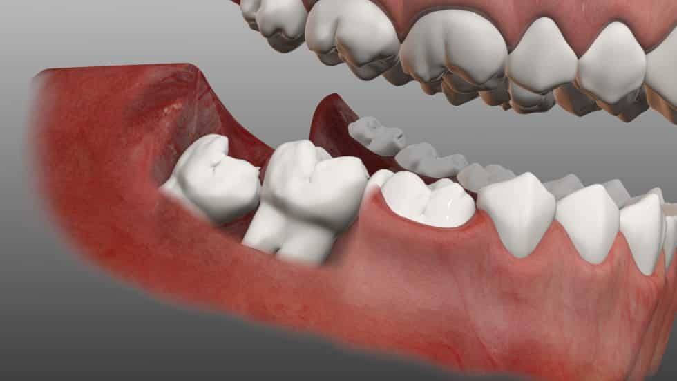 دندان عقل چیست انواع دندان عقل و مراقبت های بعد از کشیدن دندان عقل ایمپلنت دندان متخصص ایمپلنت کامپوزیت دندان بلیچینگ دندان ارتودنسی دندان لمینت دندان کلینیک دندانپزشکی مبین