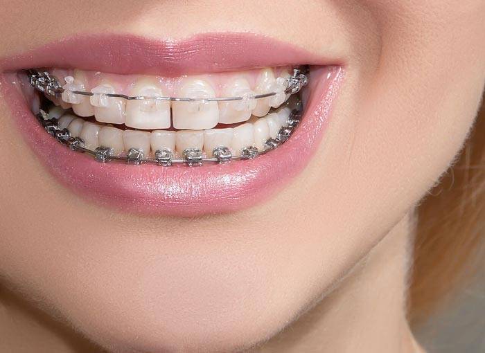 ارتودنسی و ایمپلت دندان