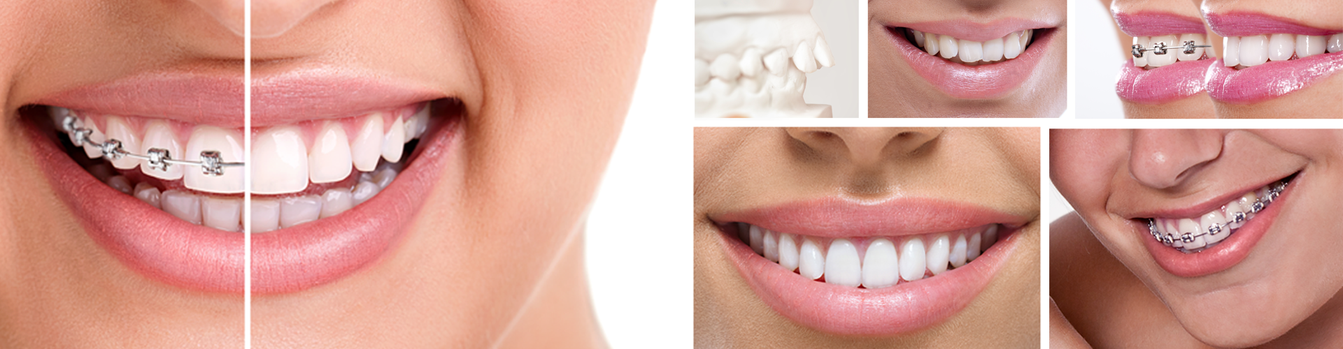 فاصله بین دندان ها دلایل و درمان