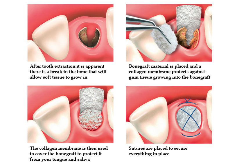 پیوند استخوان ایمپلنت دندان چگونه انجام می شود؟