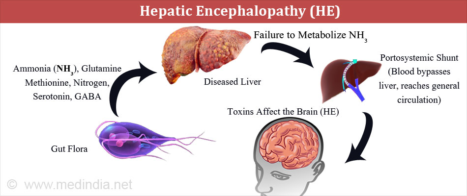 انسفالوپاتی کبدی چگونه در بدن پدید می آید؟