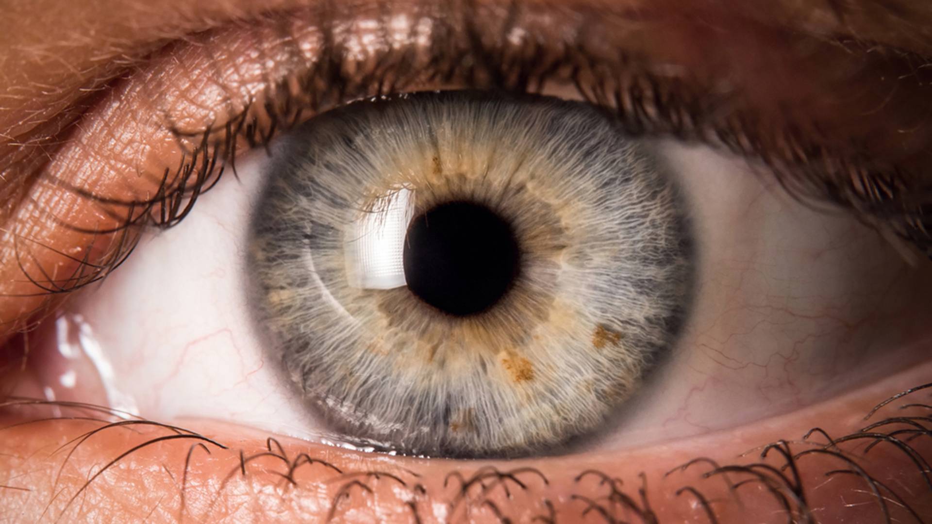 عمل ویترکتومی چیست؟ چه تاثیری در بهبود بینایی دارد؟