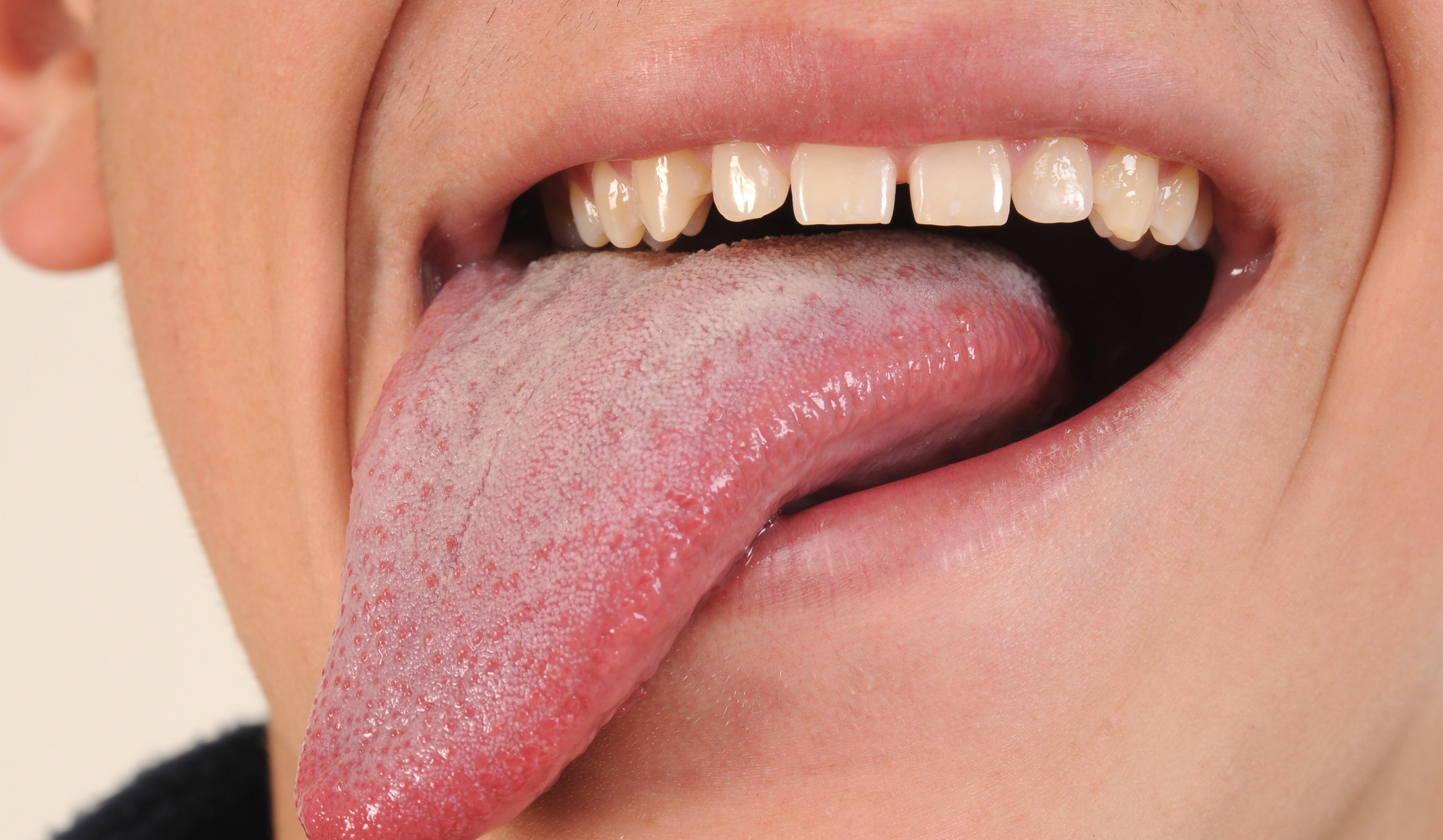 نشانه های بیماری روی زبان