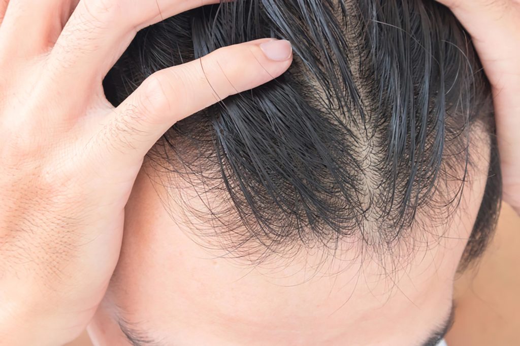 مقابله با ریزش مو علل ریزش مو ریزش مو در پاییز ریزش مو دلایل ریزش مو درمان ریزش مو پیشگیری از ریزش مو 