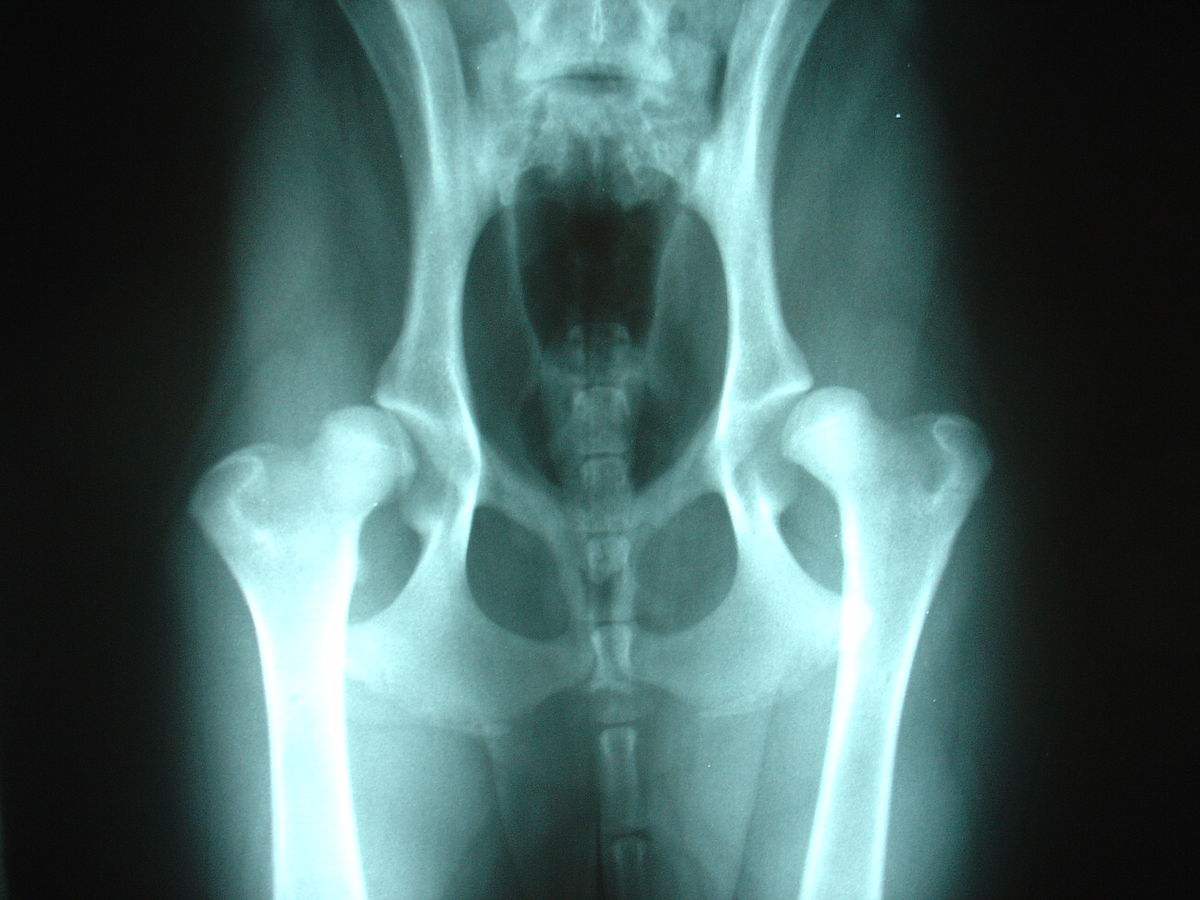 درمان های موثر برای دیسپلازی مفصل ران