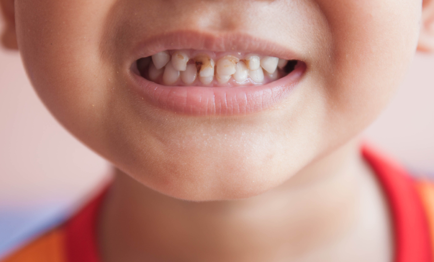 مقابله با پوسیدگی دندان با تغییر سبک تغذیه ای
