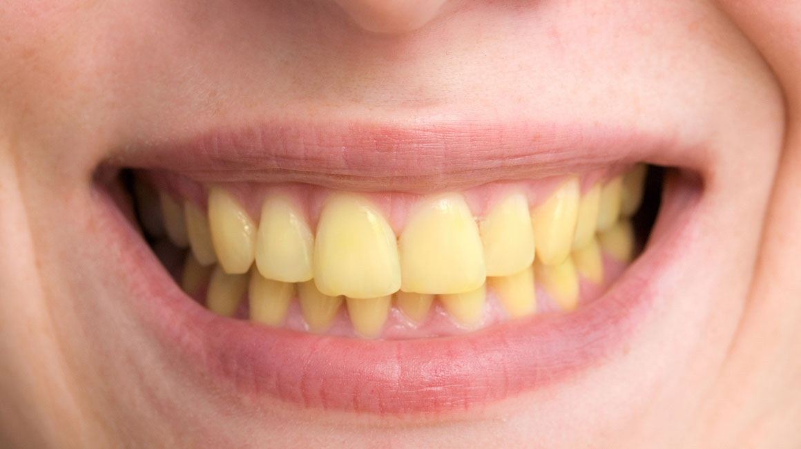 روش های رفع تیرگی و زردی دندان