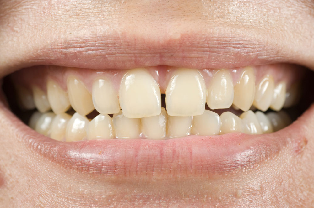 روش های رفع تیرگی و زردی دندان
