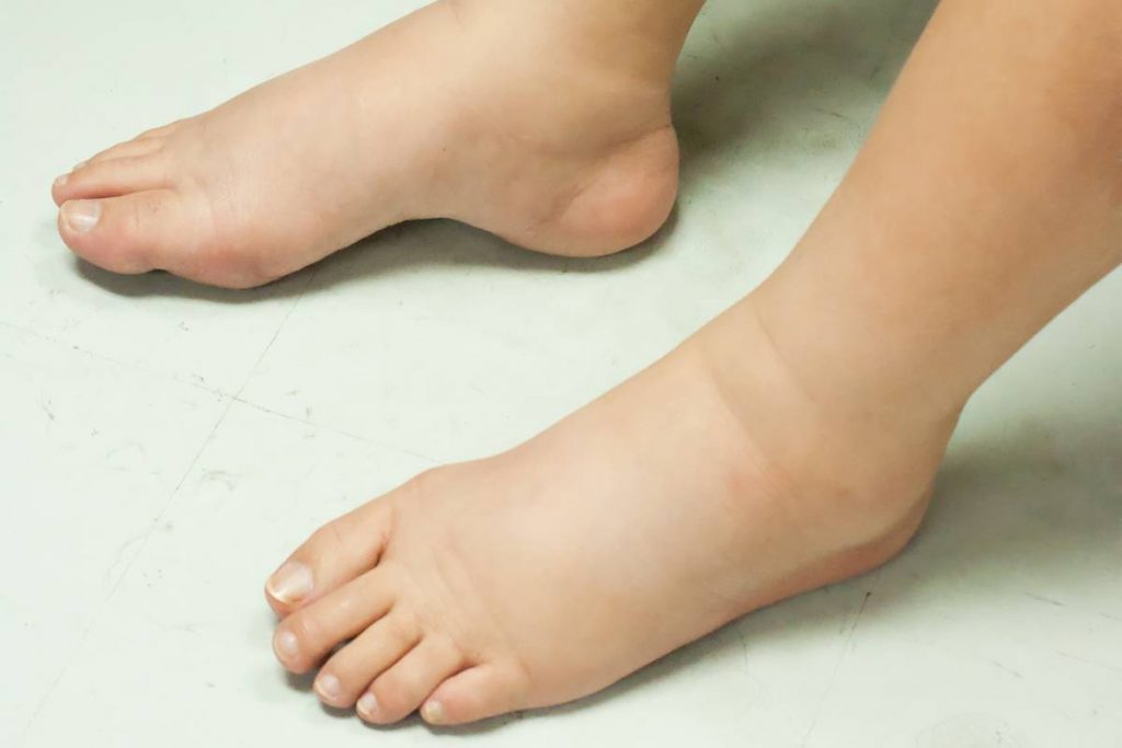 عوامل تاثیرگذار در متورم شدن پاها