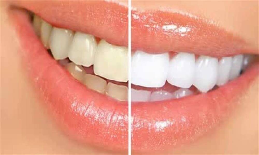 بخور نخورهای مهم برای سفید شدن دندان ها
