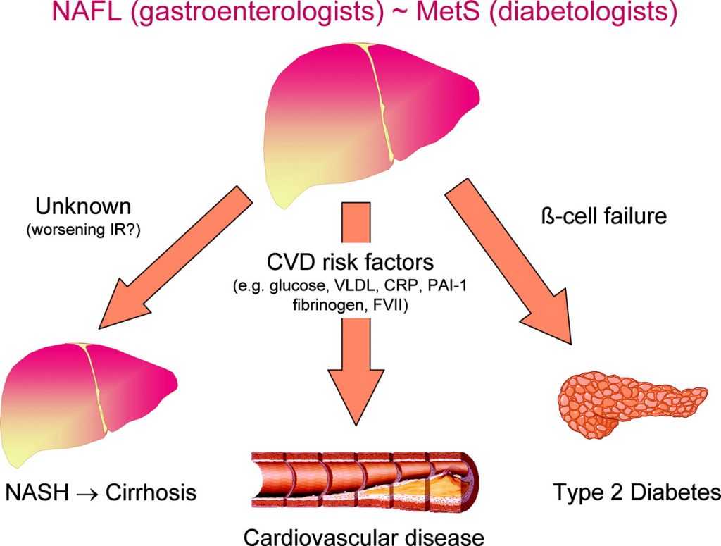 ارتباط کبد چرب با امراض قندی