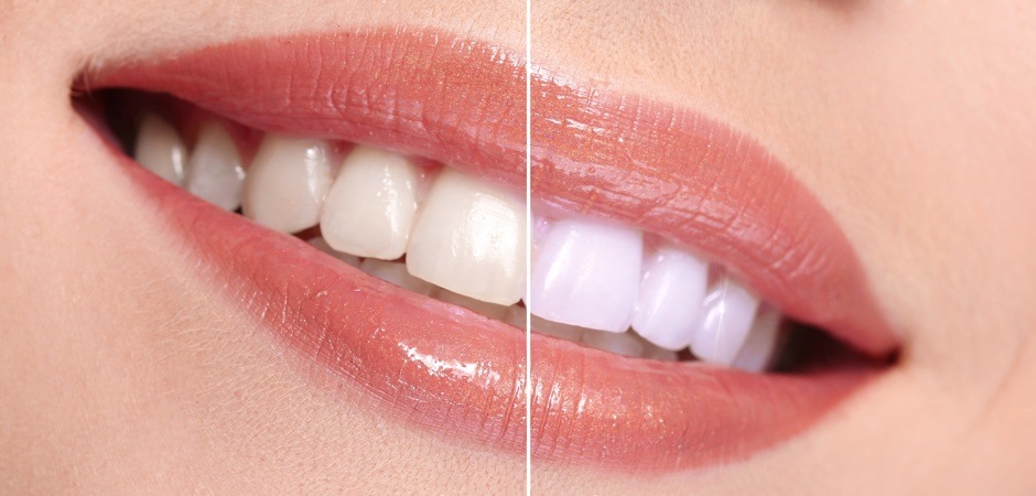 روش های موثر برای سفید شدن دندان