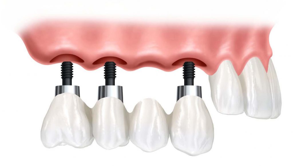 توضیحات مفید در مورد ایمپلنت دندان