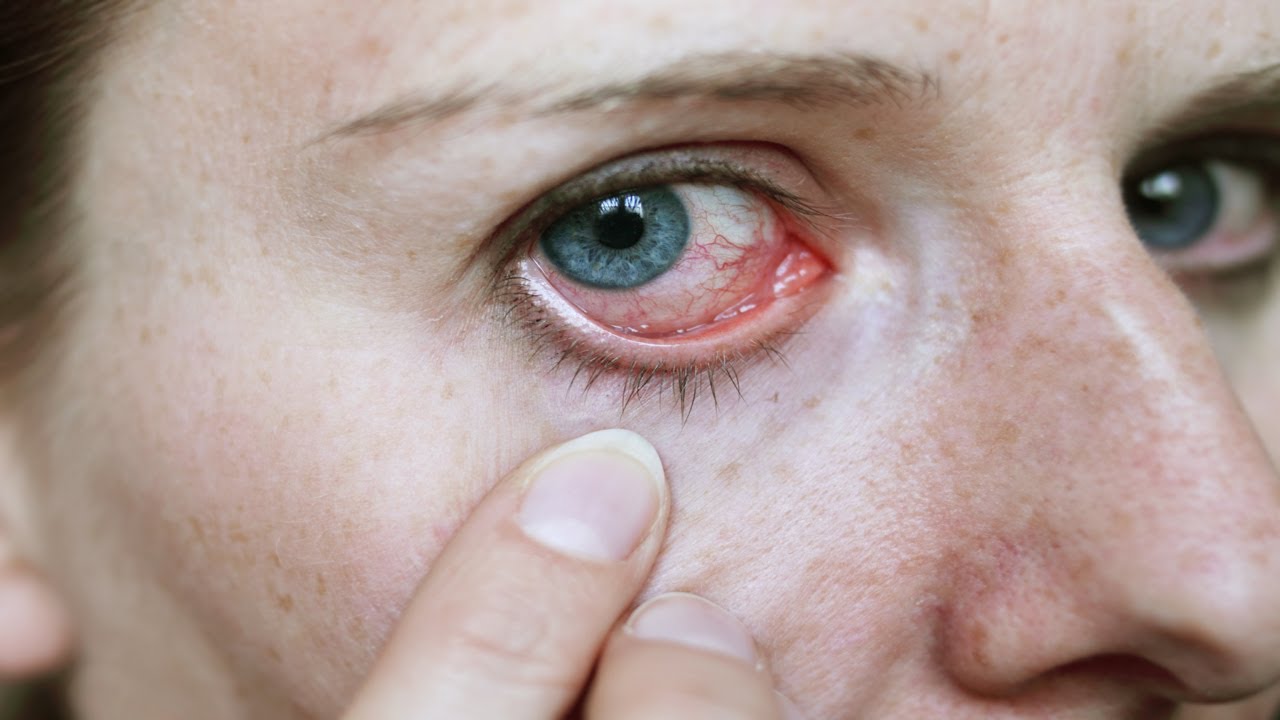 خطرات استفاده از لنز تماسی
