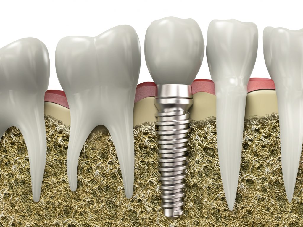 توضیحات مفید در مورد ایمپلنت دندان