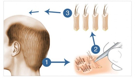  کاشت مو و ابرو طبیعی کلینیک تندیس