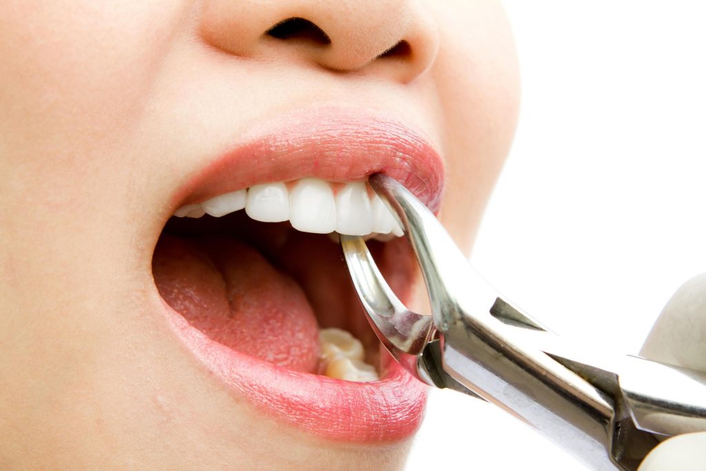 دلیل خارج کردن دندان عقل چیست؟