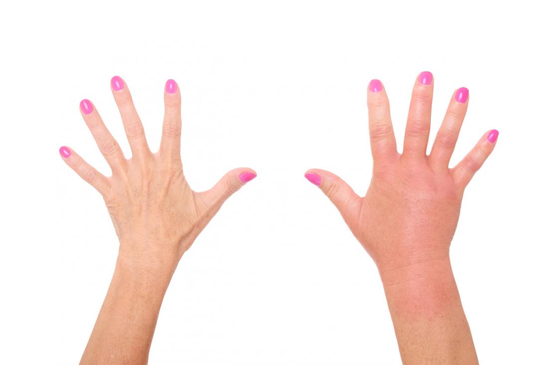 7 دلیلی که انگشتانتان متورم می شود
