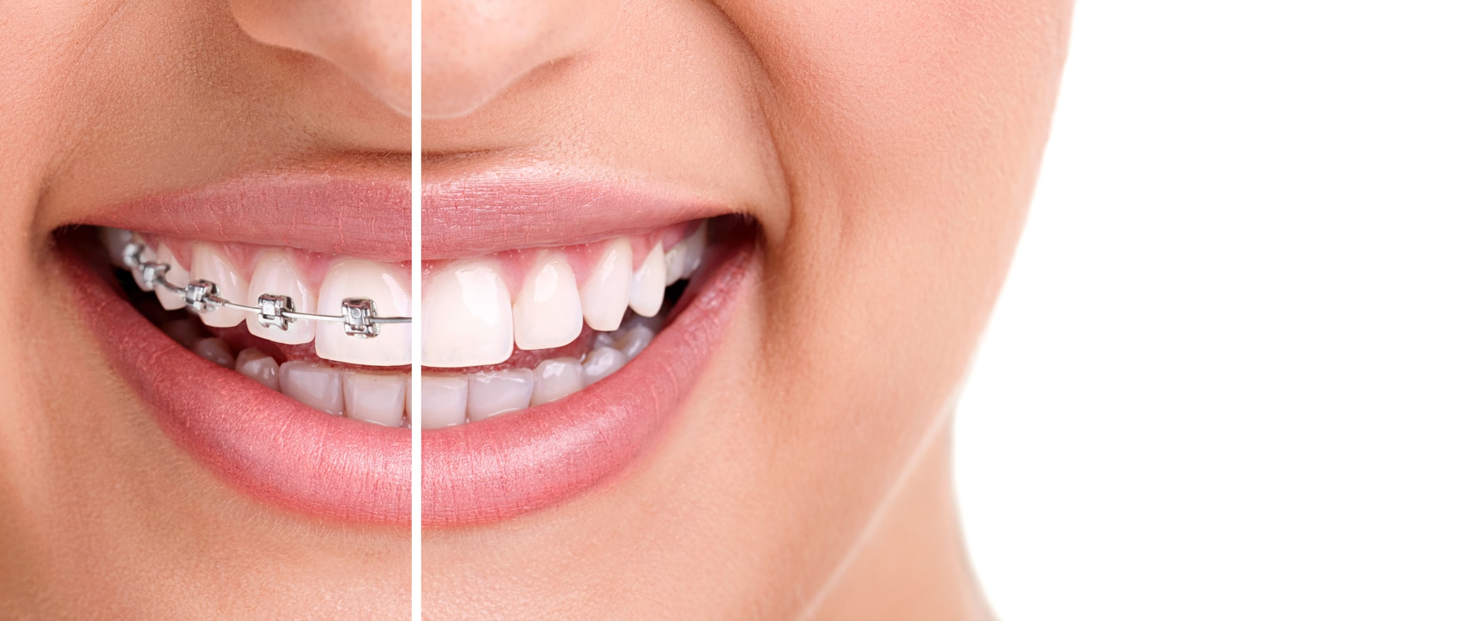 اصلاح نافرمی دندان ها با ارتودنسی دکتر آزادمنش