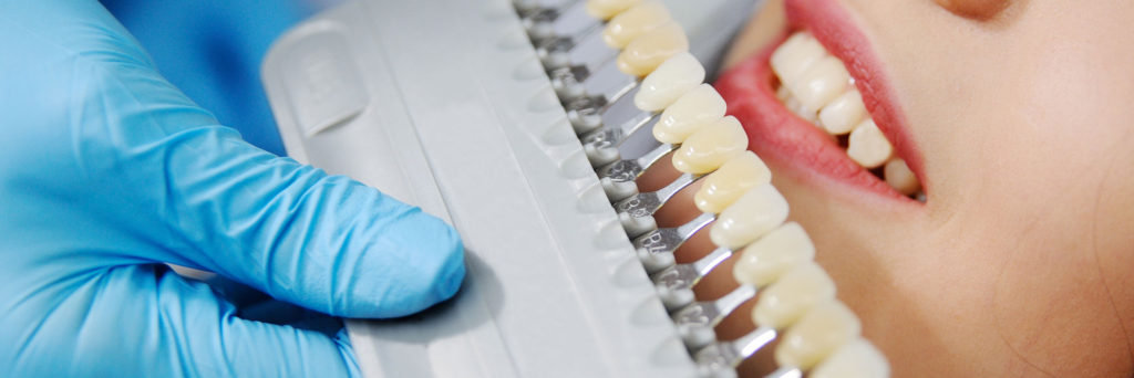 دندانپزشکی هیراد: دانستنی هایی در مورد روکش سرامیکی دندان