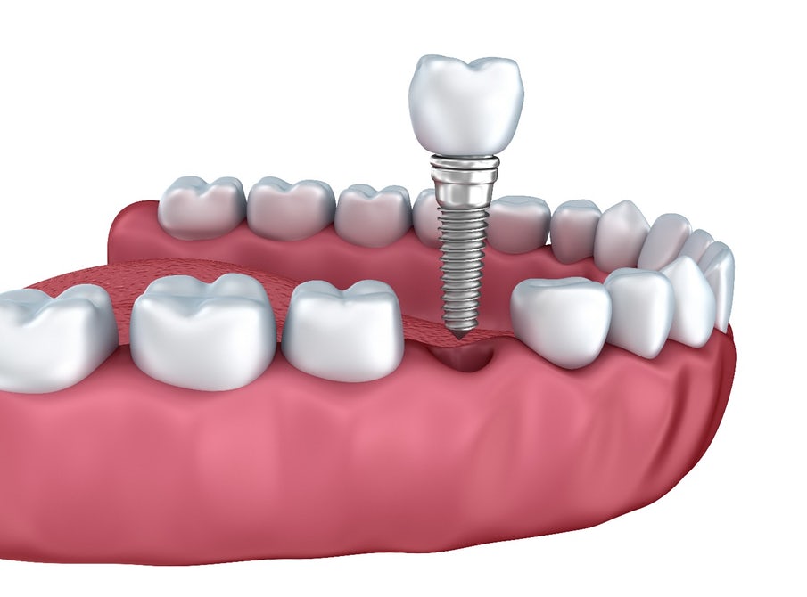 [تصویر:  dental-implant-antibacterial-2-min.jpg]
