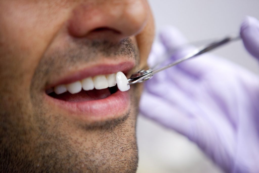 کامپوزیت ونیر دندانپزشکی نارمک