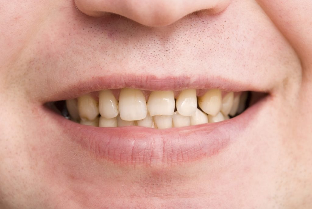 6 علت زرد شدن دندان