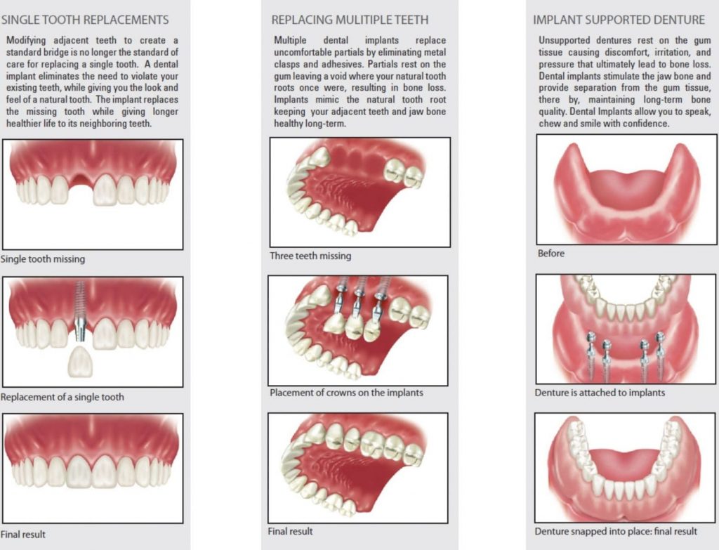 انواع ایمپلنت دندانپزشکی نارمک