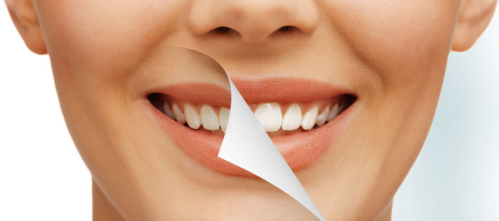 دندانپزشکی هیراد: دانستنی هایی در مورد لمینت دندان