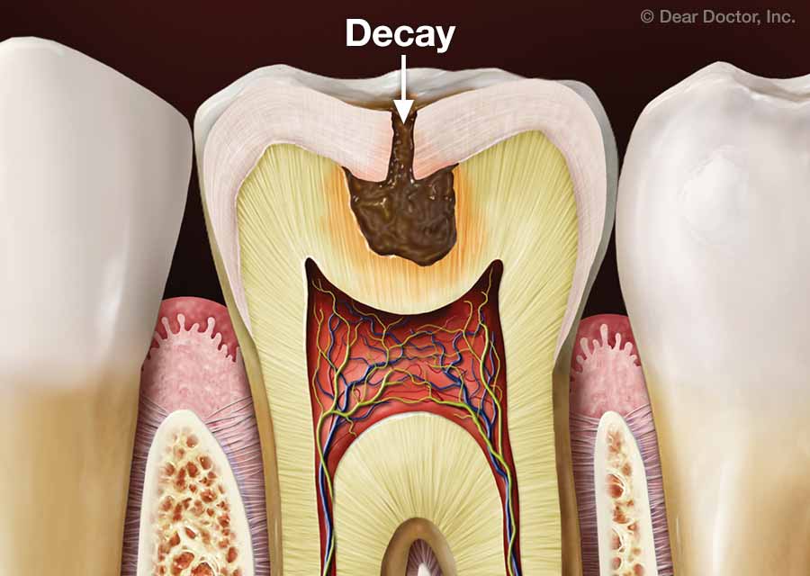 4 توصیه برای پیشگیری از پوسیدگی دندان