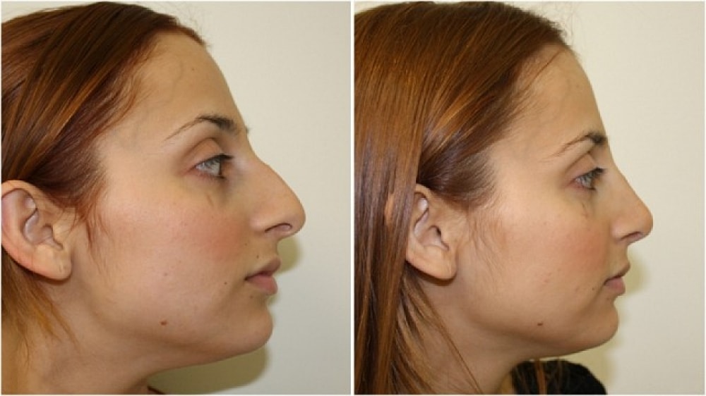 آمادگی های قبل و بعد از جراحی بینی گوشتی