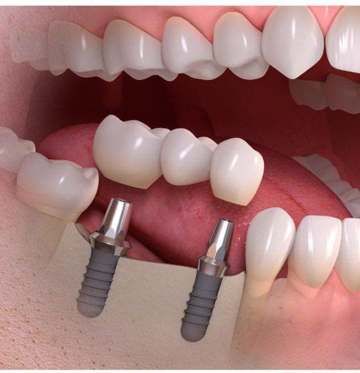 ایمپلنت دندان دکتر نظری