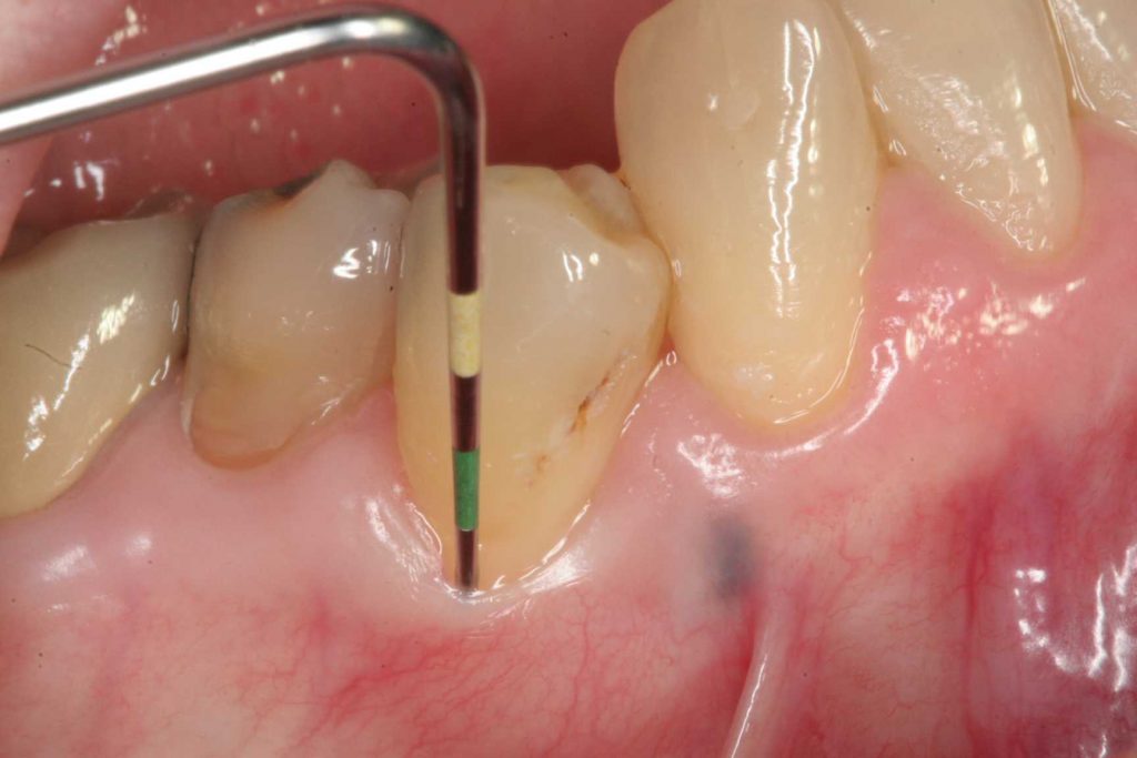 عوارض مصرف خودسرانه آنتی بیوتیک در عفونت دندان