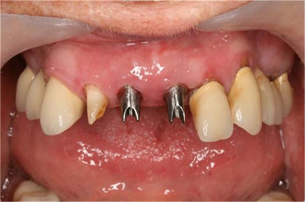 جراحی ایمپلنت دندان دکتر ترنگ آقابیگی