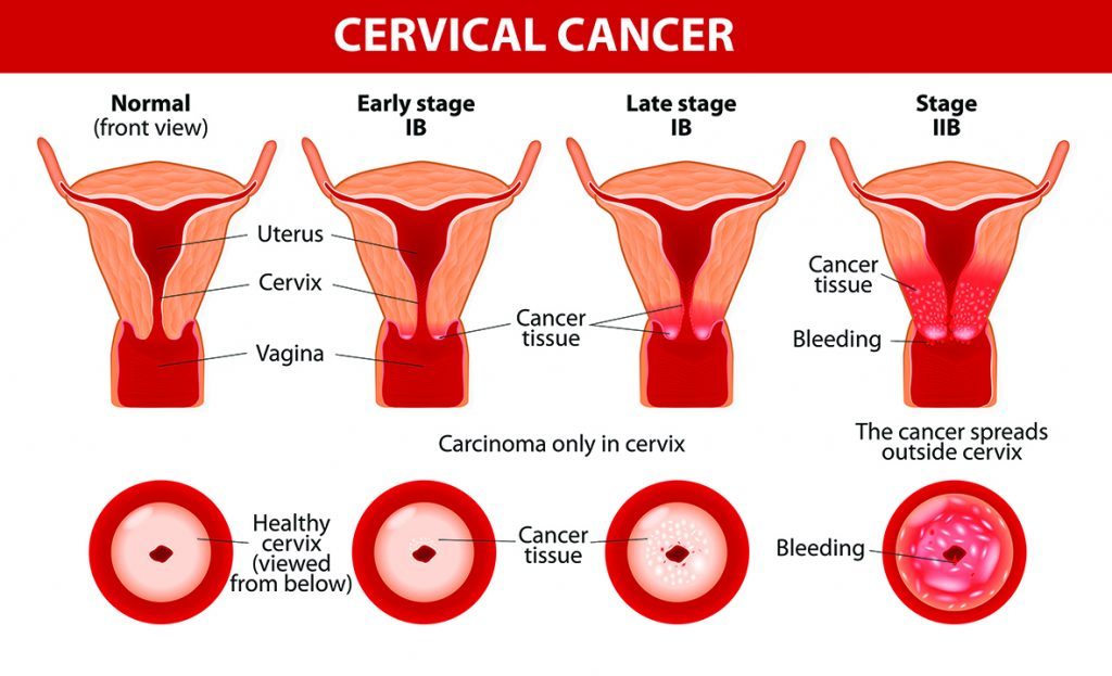 مقابله با خطرناک ترین سرطان های زنانه